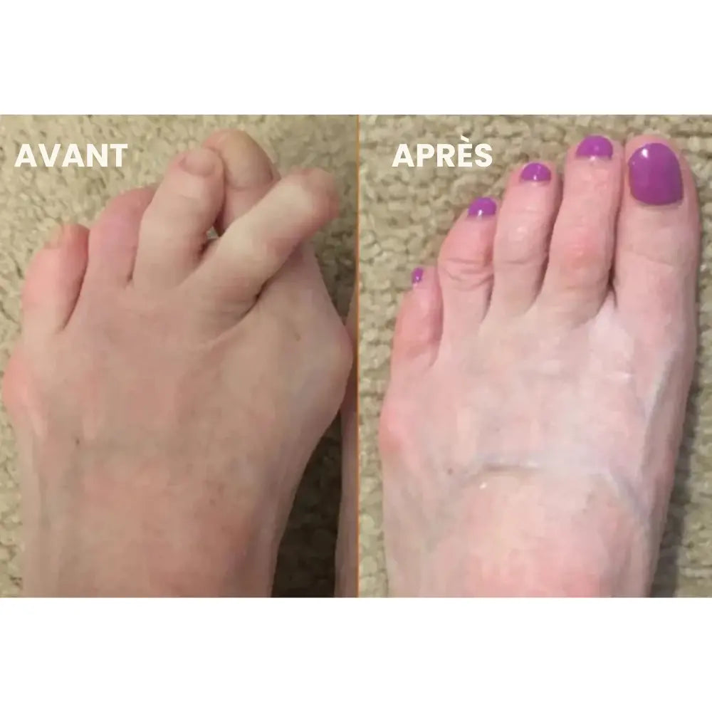 Correcteur Hallux Valgus – Soulagement Doux & Alignement Naturel