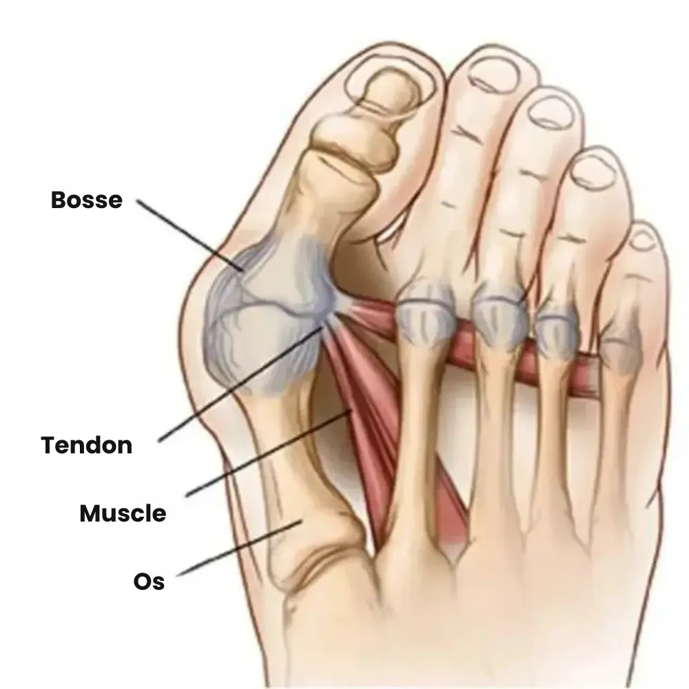 Correcteur Hallux Valgus – Soulagement Doux & Alignement Naturel