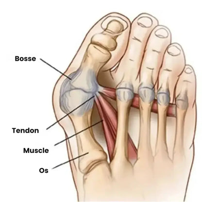 Correcteur Hallux Valgus – Soulagement Doux & Alignement Naturel