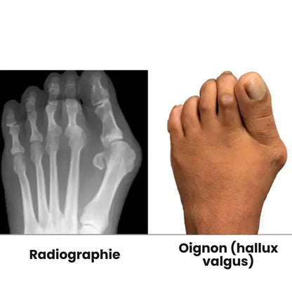 Correcteur Hallux Valgus – Soulagement Doux & Alignement Naturel